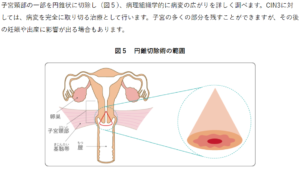 円錐切除術